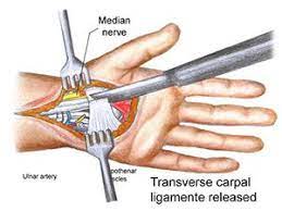 We did not find results for: Recovery Times After Carpal Tunnel Surgery Carpal Tunnel Carpal Tunnel Surgery Carpal Tunnel Surgery Recovery