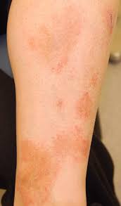 There are also two different cases of purpura, which are: Pigmented Purpuric Eruptions All Variants Schamberg S Disease Capillaritis Purpura Annularis Telangiectodes Of Majocchi Pigmented Purpuric Lichenoid Dermatitis Of Gougerot And Blum Lichen Aureus Eczematid Like Purpura Of Doucas And Kapetanakis