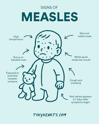 Image result for measles