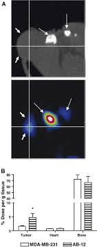 They&#x27;re both types of cancer, but at first glance, that&#x27;s where the similarities end. Differential Effects Of Ca2 On Bisphosphonate Induced Growth Inhibition In Breast Cancer And Mesothelioma Cells Sciencedirect