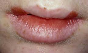 Here it is convert to hsv format and color threshold hsv = cv2.cvtcolor(image, cv2.color_bgr2hsv) mask = cv2.inrange(hsv, lower, upper) result = cv2.bitwise_and(image. How Do I Manage A Patient With Recurrent Herpes Simplex Jcda