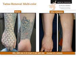 Need to remove or fade a tattoo? Laser Tattoo Removal In San Francisco Ca Advanced Aesthetics