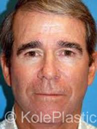 Plastic Surgery for Men