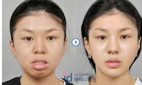 El Antes Y Despues Cirugia Plastica En Corea 2 Marcianos