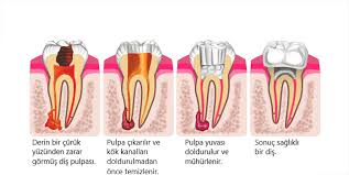 Bartın Diş Kliniği – Kanal Tedavisi