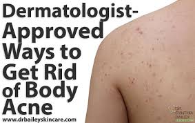 Exfoliation gets rid of dead skin cells on. Pin On Acne Tips And Products