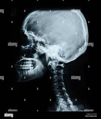 Image result for Skull XRay