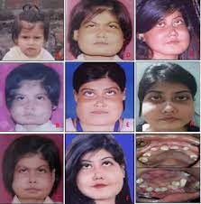 Pdf | cherubism is a rare developmental jaw condition that is generally inherited as an autosomal dominant trait with high all rights reserved. Clinicoradiologic Follow Up Of Cherubism With Aggressive Characteristics A Series Of 3 Cases Oral Surgery Oral Medicine Oral Pathology And Oral Radiology