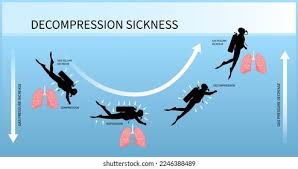 Image result for Decompression Sickness