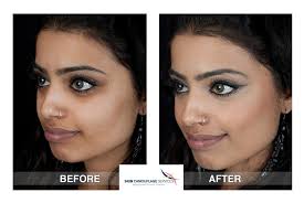 If you're considering getting a face tattoo that's subtle and badass at the same time, a tattoo under the eye can be a great place to start! Sin Camouflage Services Ltd Patient Gallery