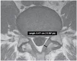 The ligamenta flava (singular, ligamentum flavum, latin for yellow ligament) are a series of ligaments that connect the ventral parts of the laminae of adjacent vertebrae. Scielo Brasil Thickness Of The Ligamentum Flavum Of The Spine And Its Relationship With Disc Degeneration Thickness Of The Ligamentum Flavum Of The Spine And Its Relationship With Disc Degeneration