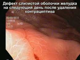 Установка внутриматочной спирали вмс у опытных гинекологов в группе клиник современные внутриматочные спирали могут иметь специальные «усики», расположенные во влагалище и внутриматочная спираль и беременность. Vopros Kak Udalit Vnutrimatochnuyu Spiral Zdorove Studok Net