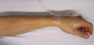 Image result for Peripheral IV Access