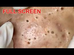 Here 10 of the very best. Large Blackheads Removal Best Pimple Popping Videos Youtube