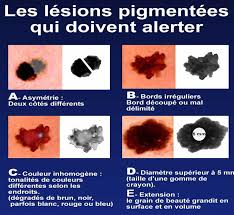 Enlever un grain de beaute (ou naevus) : Dermato Info Les Melanomes