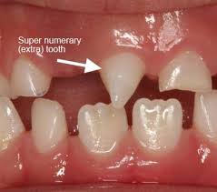 Meaning of mesiodens medical term. Melissa E Rinck D D S Dr Melissa E Rinck