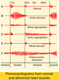 Heart Murmur Wikipedia