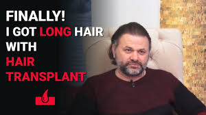 In order to experience the complete result of a hair transplant, the patient needs to wait for six to nine months. Can I Grow Long Hair After Hair Transplant Featured Patient Review Youtube