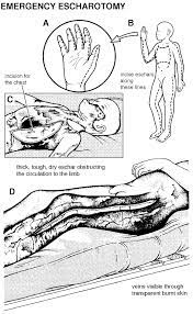 It restores blood flow and allows adequate ventilation. Roman Breastplate Litfl Clinical Cases Trauma Tribulation