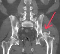 A joint dislocation occurs when the if you notice the symptoms of a dislocation while your regular veterinary clinic is closed, it's a good if my cat's hip is dislocated, can the vet fix him in the office without needing surgery? 7 Best Hip Dislocation Ideas Hip Dislocation Dislocation Hip Brace