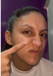 El💚tea tree💚 siempre me salva!! Para esos días que los granitos  aparecen😢 #teatree #teatreeserum #farmasi #acne