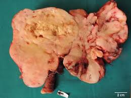 Image result for Leiomyosarcoma