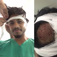 Raftaar On Twitter After A Fight With Alopecia Areata I Finally Got A Transplant Surgery Done No One Will Judge Me Anymore Hahaa Shredded brothers ile hedeflerinize ve kişiye oezel hazirlanan uzaktan egitim programi hemen başlamak ve hayata gecirmek icin burayi tiklayin! alopecia areata
