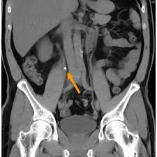 Pin On Kidney Stone Diet Removal