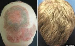 Biotin Before And After Hair Biotin Hair Regrowth Before And After Visit The Image Link For More Details Hairlosstreatment Help Hair Loss Alopecia Universalis Baldness Cure