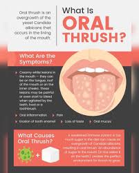 Image result for oral thrush symptoms roof of the mouth