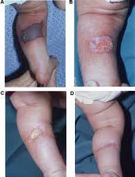 Petechiae are small, purpuric lesions up to 2mm across, and ecchymoses or bruises are larger. Purpura Fulminans Recognition Diagnosis And Management Archives Of Disease In Childhood