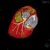 They often run parallel to one another and are variable in number (often 2 to 9). Diagonal Branches Of The Left Anterior Descending Artery Radiology Reference Article Radiopaedia Org