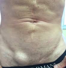 Image result for Inguinal hernia man
