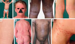 Image result for Atopic eczema atopic dermatitis