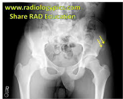 The anterior superior iliac spine refers to the anterior extremity of the iliac crest of the pelvis. Pin On Msk