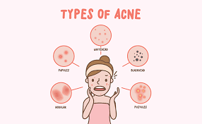 Agar Tak Keliru Ini Dia 5 Hal Yang Perlu Anda Ketahui Sebelum Menggunakan Acne Spot Treatment Beauty Journal