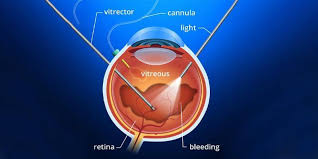 At the time you make the appointment, ask if you need to do anything in advance. Vitrectomy Surgery Risks And Postoperative Care Neoretina