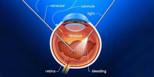 Sep 22, 2020 · your surgery may not work if you do not recover in the recommended position. Vitrectomy Surgery Risks And Postoperative Care Neoretina
