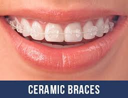 Online affordable replacement teeth retainers. Brace Retainer Invisalign Dentist In Angel Islington London Angel Smile
