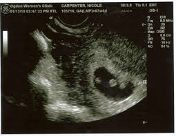 Ultrasound images in the first trimester of: A Tale Of Two Heartbeats Twins For The Show Learning To Juggle Twins
