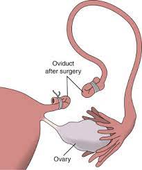 Tubal Occlusion Insert An Overview Sciencedirect Topics
