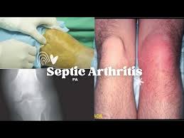 Image result for Septic Joint