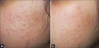 Retinoic Acid And Glycolic Acid Combination In The Treatment Of Acne Scars Abstract Europe Pmc