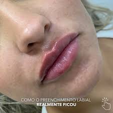 ✨ Nas últimas semanas o que mais temos visto são notícias a respeito de  procedimentos que foram mal sucedidos na harmonização facial, e isso tem  causado espanto e medo naqueles que tem