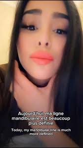 ✨ Endolift®: Natural definition without fillers, Three months ago, this  patient travelled from Paris to Barcelona to have her Endolift treatment  with me. Today, her jawline looks more defined, her ...