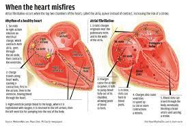 Atrial Fibrillation | Heart Rhythm Consultants