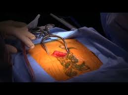 Laminectomy Performed By Dr Grigory Goldberg Youtube