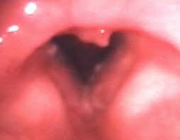 Image result for Reflux Laryngitis