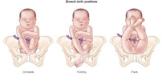 Kedudukan bayi anda dalam kandungan pada waktu ini masih sama. Ciri Ciri Posisi Bayi Sungsang Yang Wajib Moms Ketahui Good Doctor Tips Kesehatan Chat Dokter Beli Obat Online