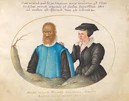 Hypertrichosis Wikipedia